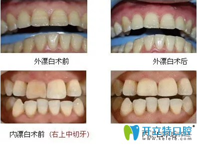 漂白牙對比案例