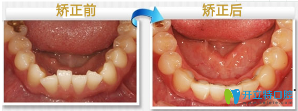 致美口腔隱形矯正案例