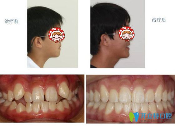 兒童牙齒矯正案例及前后對比圖