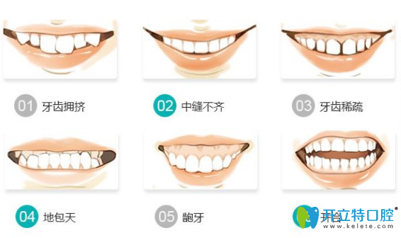 需要矯正牙齒的6種類型