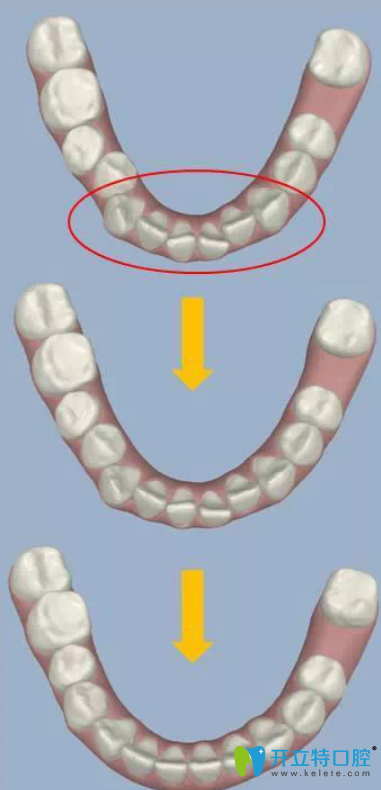 、醫(yī)師在3D數(shù)碼模型上模擬矯正療程