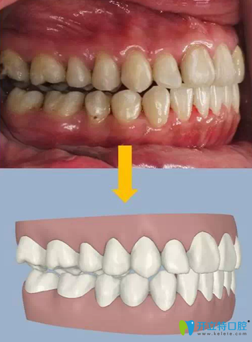 3D數(shù)碼隱形正畸矯正步打印3D數(shù)碼模型