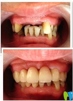 威海舒好王醫(yī)生牙體缺失修復(fù)案例對(duì)比圖