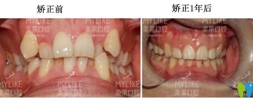 牙齒正畸1年后對比圖片