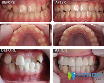 東莞拜博口腔牙齒矯正案例