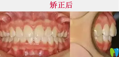 清遠(yuǎn)中大口腔隱形牙齒矯正后效果