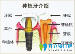 廣州好大夫口腔“分分鐘”微創(chuàng)無痛即種即用種植牙介紹