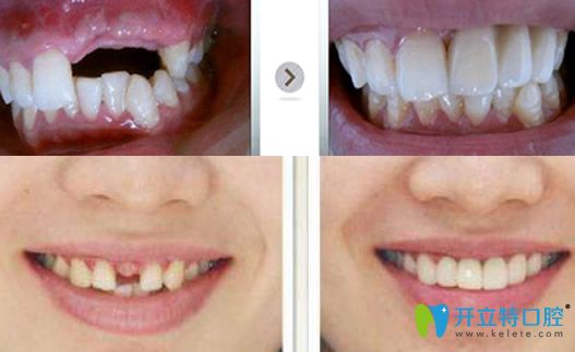 舒斯特牙齒種植案例前后對比照片