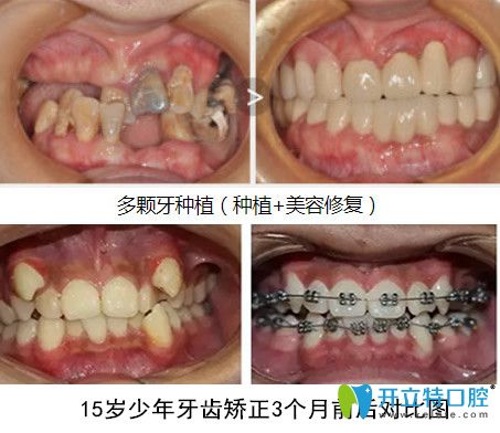 牙齒種植+青少年牙齒正畸案例前后對(duì)比照