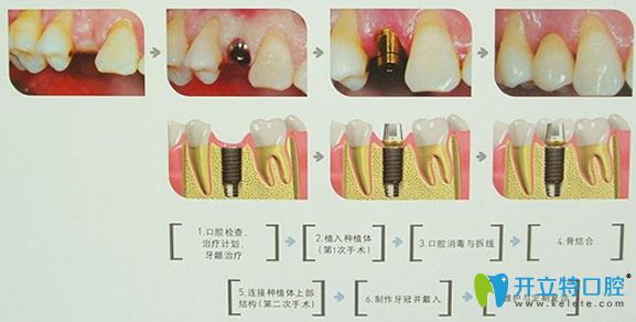 北京科爾口腔種植牙的步驟