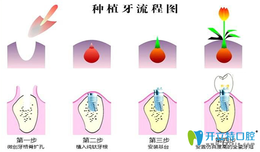 種植牙好不好？公布種植牙種類和2018全新價(jià)格表