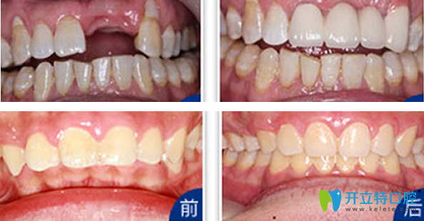 天津拜博口腔種植牙+牙齒矯正效果案例