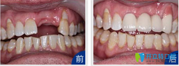 天津拜博口腔門(mén)牙缺失種植效果