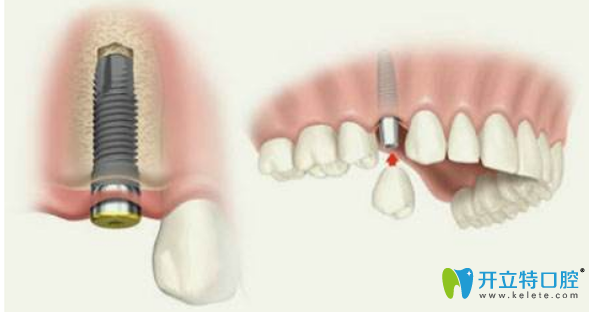 種植牙分為三個步驟