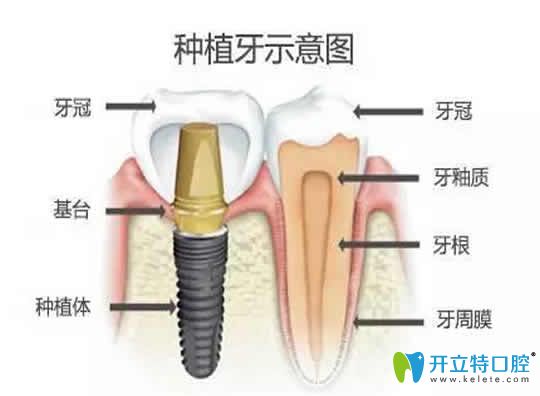 無錫康貝佳口腔醫(yī)生揭露：比種植牙更好的方法及價(jià)格