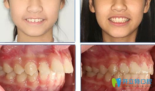 齙牙矯正必須拔牙嗎?看北京維恩口腔楊占娟兒童正畸案例