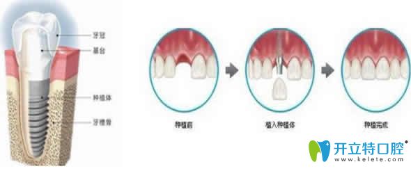 揭秘：人工種植牙價(jià)格及瑞士ITI/韓國登騰等種植體品牌