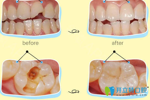 華美楊松補牙治療術(shù)前術(shù)后對比案例