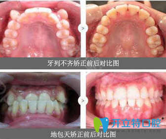 閆路牙齒矯正真人案例