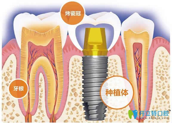 牙友們別問種植牙的價(jià)格了，先來看自己適合種牙嗎