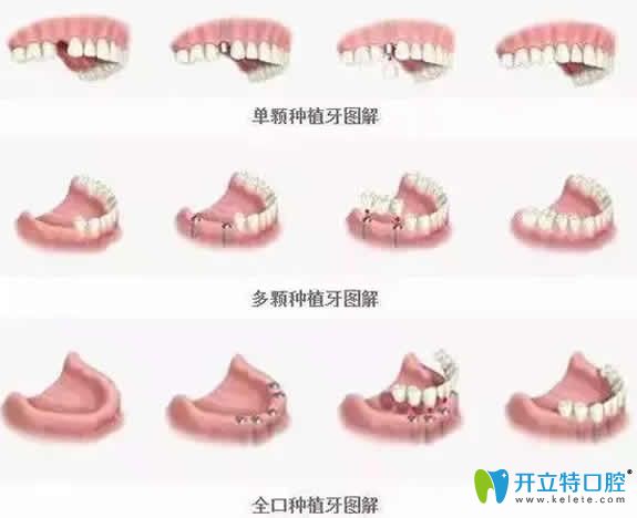 種植牙適合哪些人