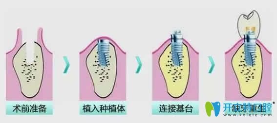  全面揭秘：即刻種植牙步驟及2024全國種植牙價(jià)格表