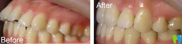 齙牙矯正前后效果對(duì)比案例