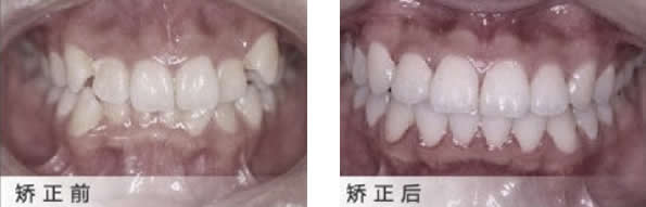 大連佳美口腔典型的外凸虎牙矯正案例 楊明亮醫(yī)生親自打造