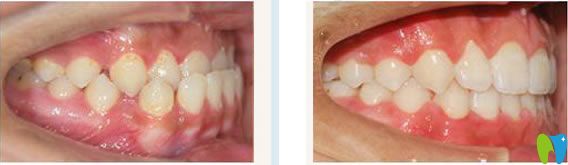南寧柏樂口腔陳世穩(wěn)門牙反頜矯正案例及前后對(duì)比效果