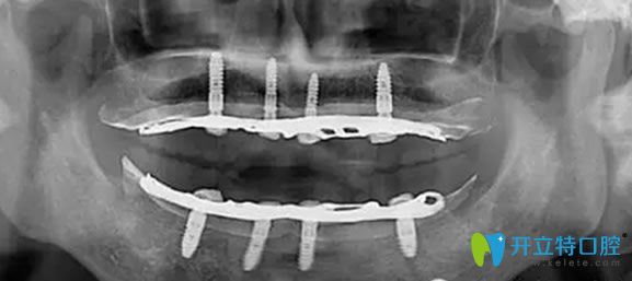 全口數(shù)字化X光影像