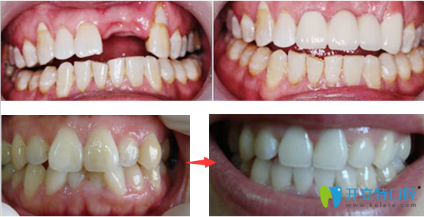 佛山壹加壹口腔種植牙+正畸效果案例