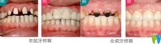 珠海愛思特韓繼新院長牙齒修復案例