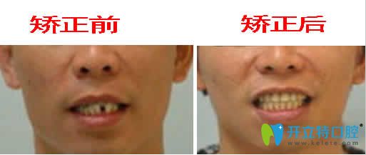 廣州偉聯(lián)口腔反頜矯正前后對比圖