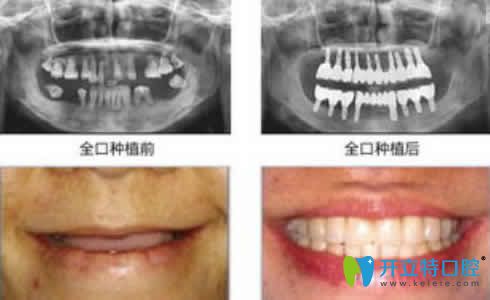 湛江致美口腔李啟森全口種植牙案例效果