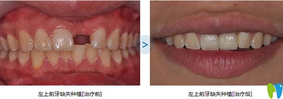 維樂口腔單顆牙缺失種植效果