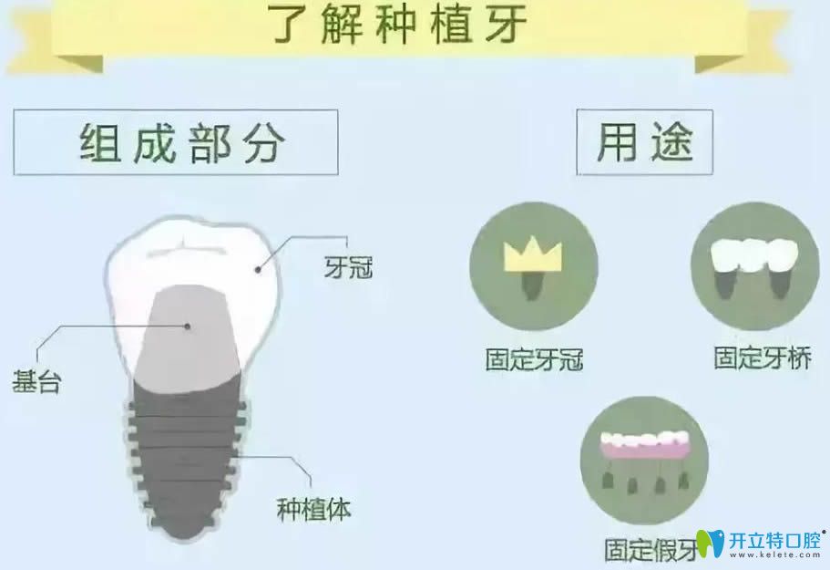 種植牙的組成部分和用途決定了它的收費(fèi)價(jià)格