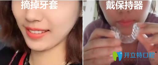 33歲的我戴舌側(cè)隱形牙套12個(gè)月矯正效果