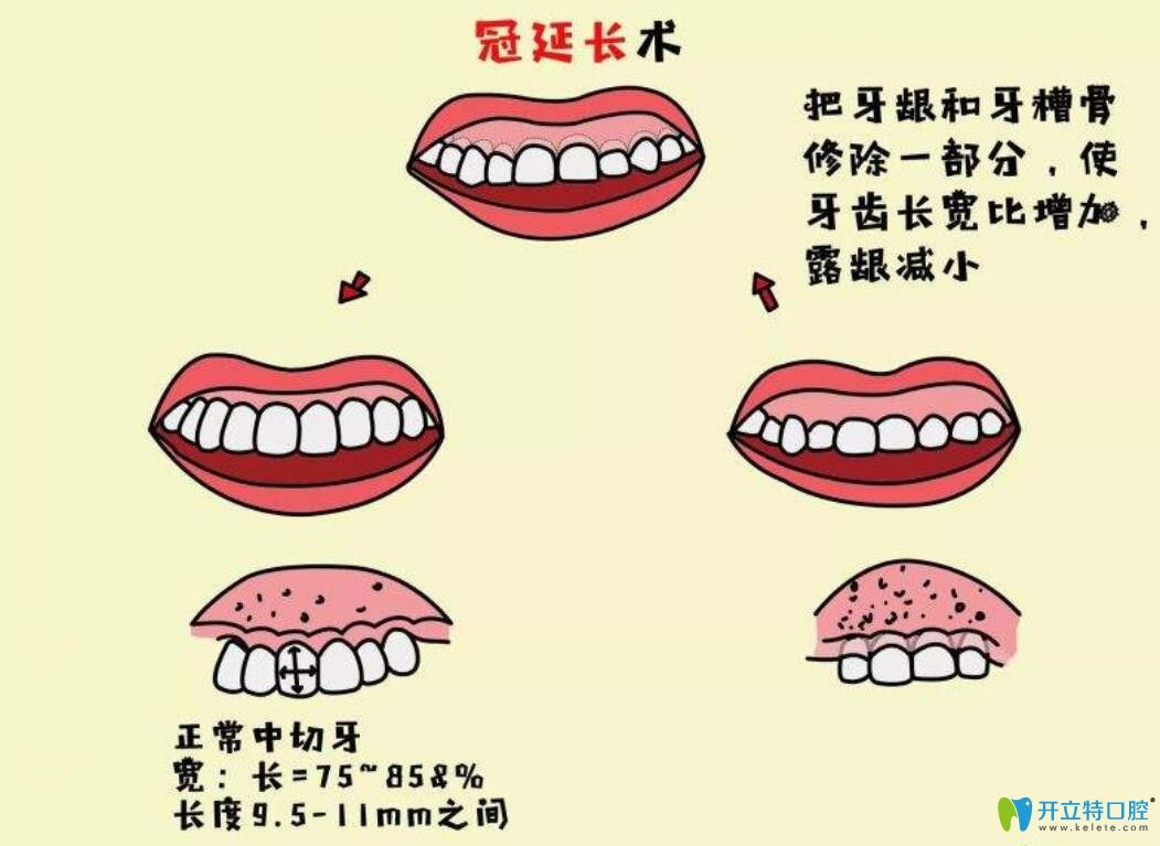 牙冠延長(zhǎng)術(shù)是什么，有什么作用