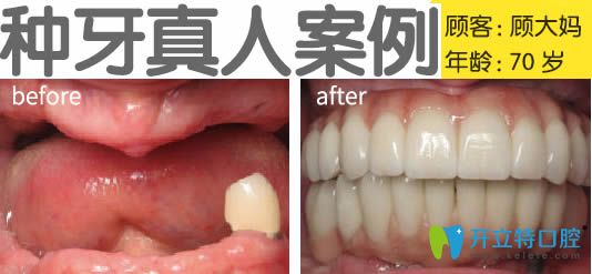 無錫北極星口腔種植牙真人案例效果圖