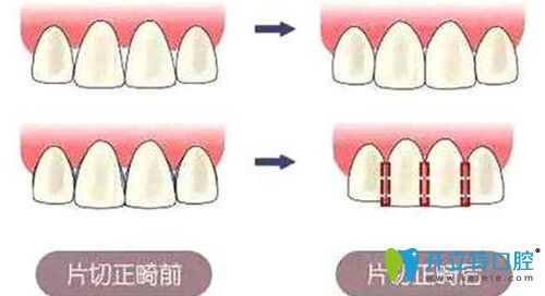 牙齒片切的危害