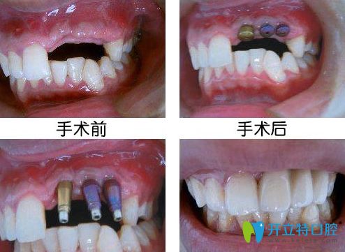 <!--<i data=20240703-sp></i>-->科美口腔程桂永醫(yī)生種植牙案例