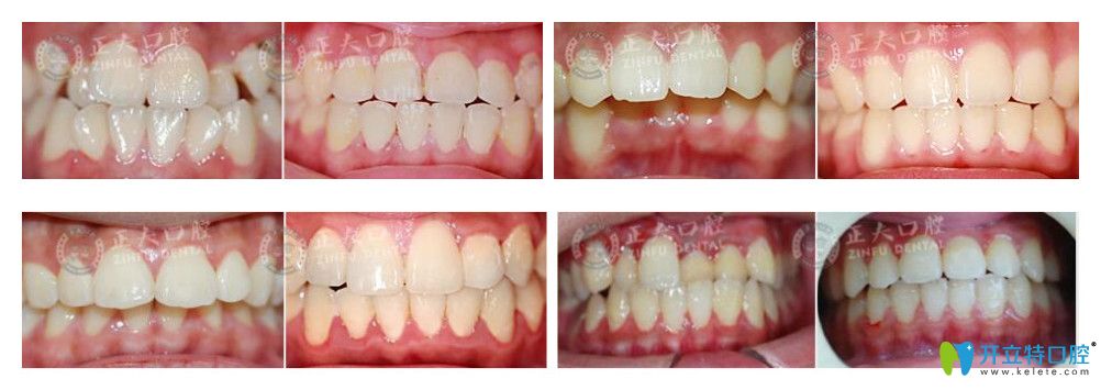 深圳正夫口腔徐國強lh魔法絲矯正案例效果對比圖