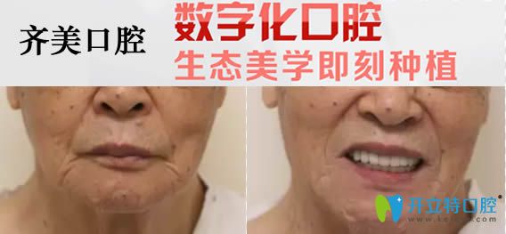 重慶齊美口腔60歲老人全口種植牙對(duì)比效果