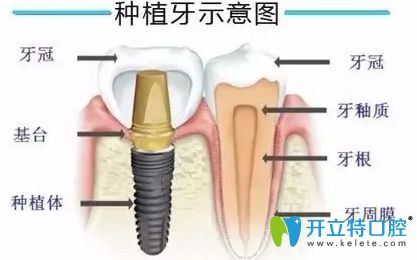 種植牙的價(jià)格為什么這么貴？醫(yī)生解開(kāi)的秘密竟然是......