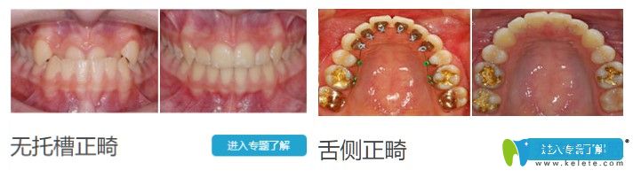 昆明德韓口腔青少年地包天矯正前后對(duì)比照