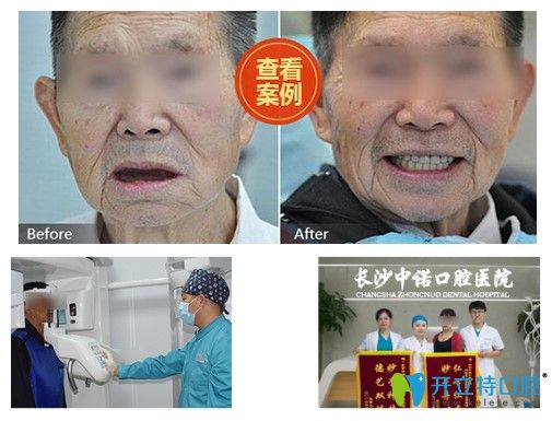 北京中諾口腔60歲老人全口牙種植前后對(duì)比效果圖