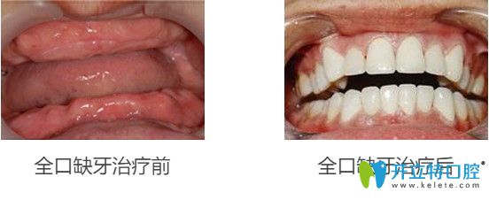 65歲王先生做完立得用全口種植牙后對(duì)比效果