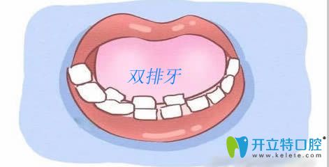 孩子門牙里面又長(zhǎng)出小門牙是咋回事?洛陽(yáng)九龍口腔帶您了解