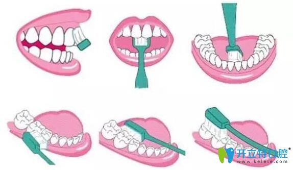 梅州中大口腔醫(yī)生科普種植牙術(shù)后清潔方法
