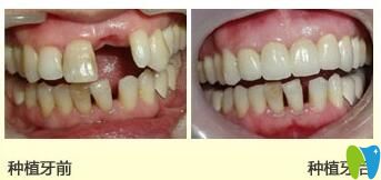 清華陽光口腔種植牙效果